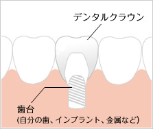 オールセラミックス（エンジェルクラウン）のイメージ